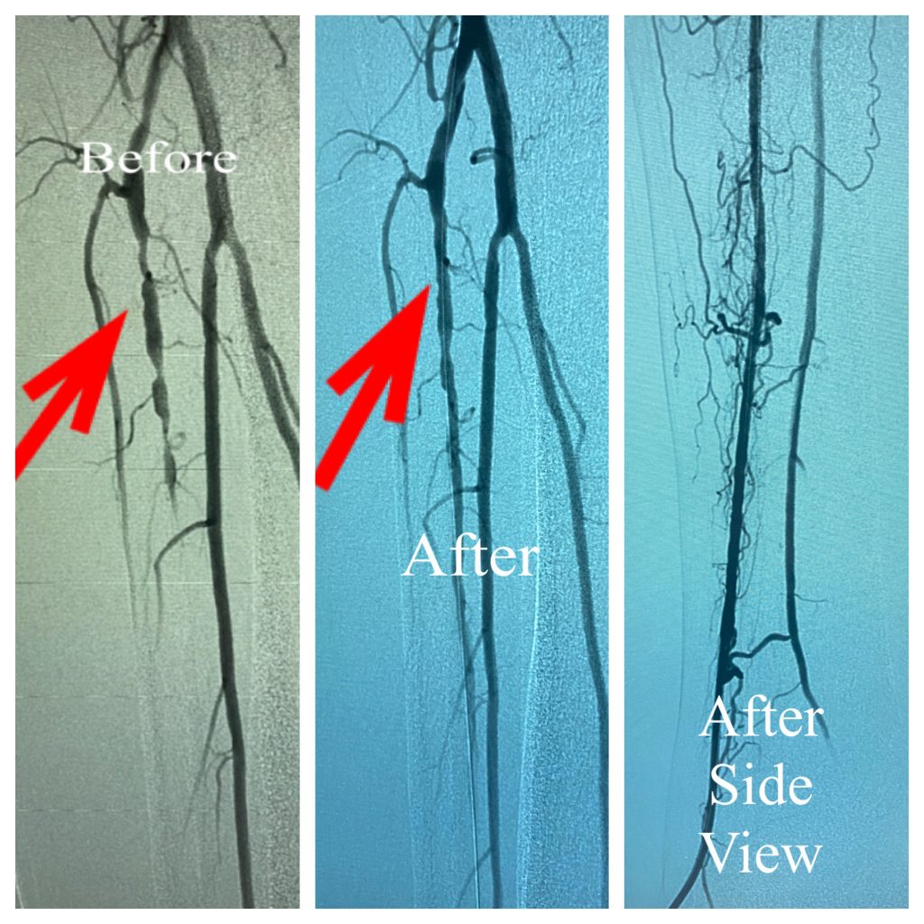 Before and after of the anterior tibial artery to improve blood flow to a non healing ulcer.